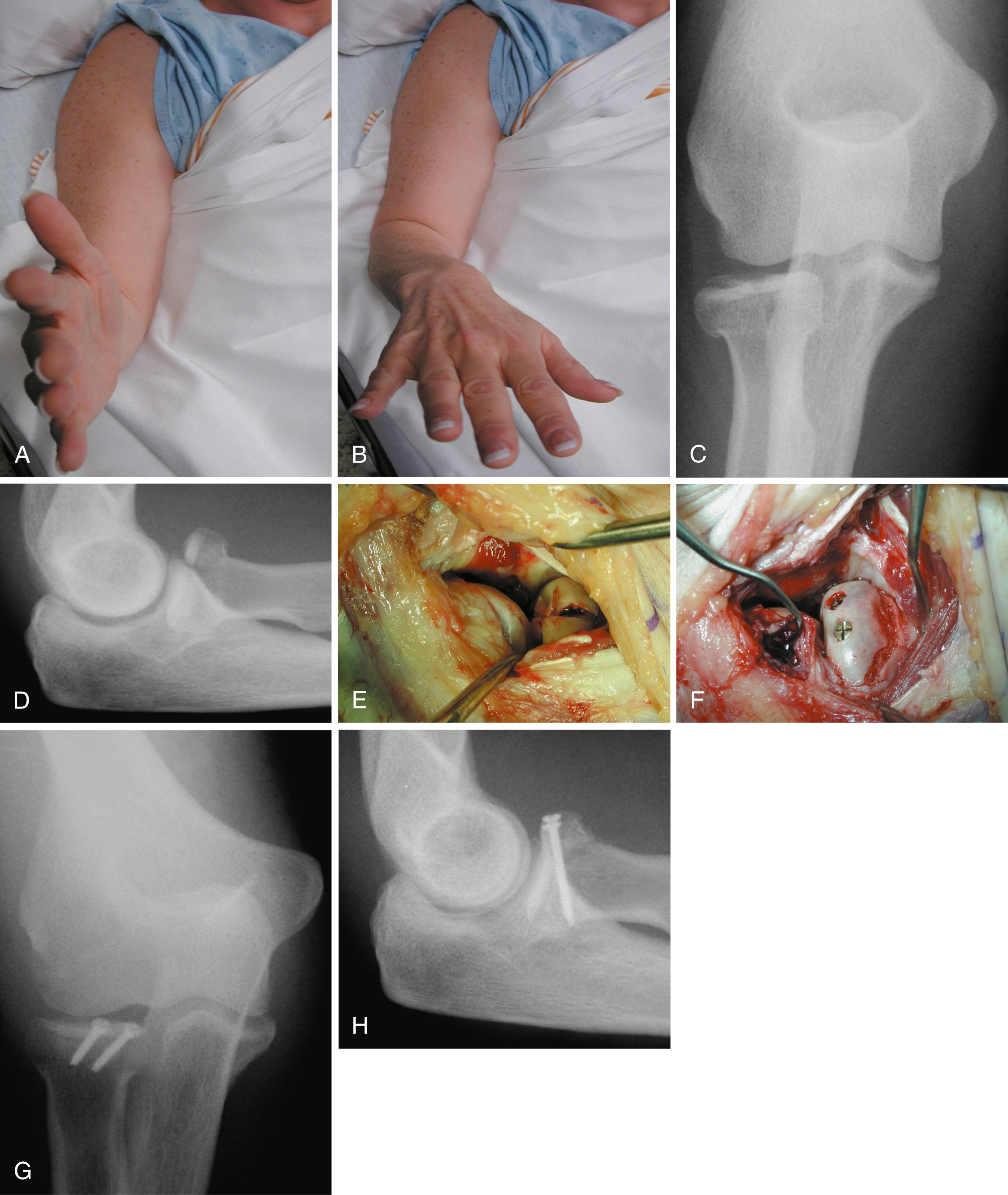 Fig. 19.6, Capitellar cartilage shear fracture. A and B, Clinical photos of a 49-year-old woman with a persistent block to supination 2 weeks after a minimally displaced fracture of the radial head. C and D, Preoperative anteroposterior and lateral radiographs demonstrating a displaced fracture of the radial head. E, Intraoperative photograph of cartilage shear fracture. F, Intraoperative photograph demonstrating reduction of the fracture with two 2.0-mm screws and cancellous bone grafting of the radial neck from the lateral epicondyle. G and H, Postoperative anteroposterior and lateral radiographs after open reduction and internal fixation of the radial head and debridement of the capitellum.