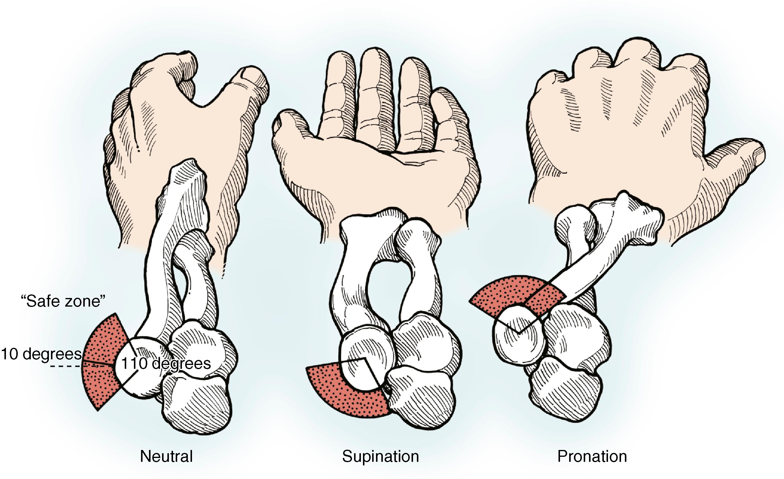 Fig. 19.8, Nonarticular portion of the radial head. The nonarticular portion “safe zone” of the radial head can be identified as a 110-degree arc centered on a point 10 degrees anterior to the midpoint of the lateral side of the radial head with the forearm in neutral rotation.