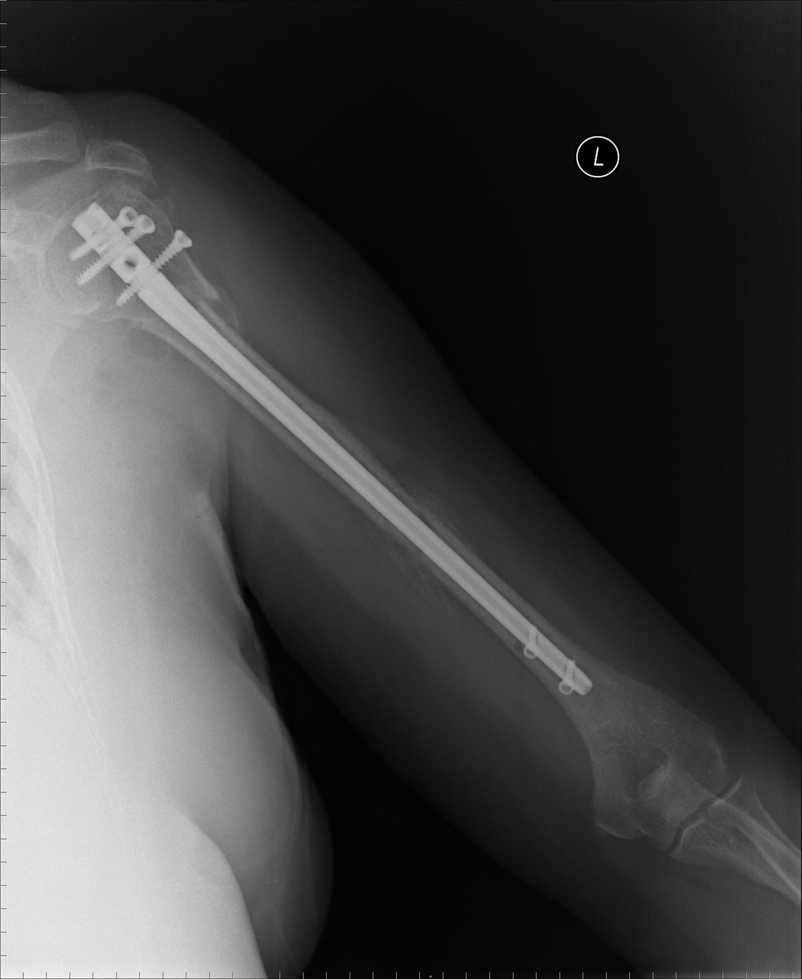 FIGURE 57.27, Fixation of segmental proximal humeral fracture with locked intramedullary nail.