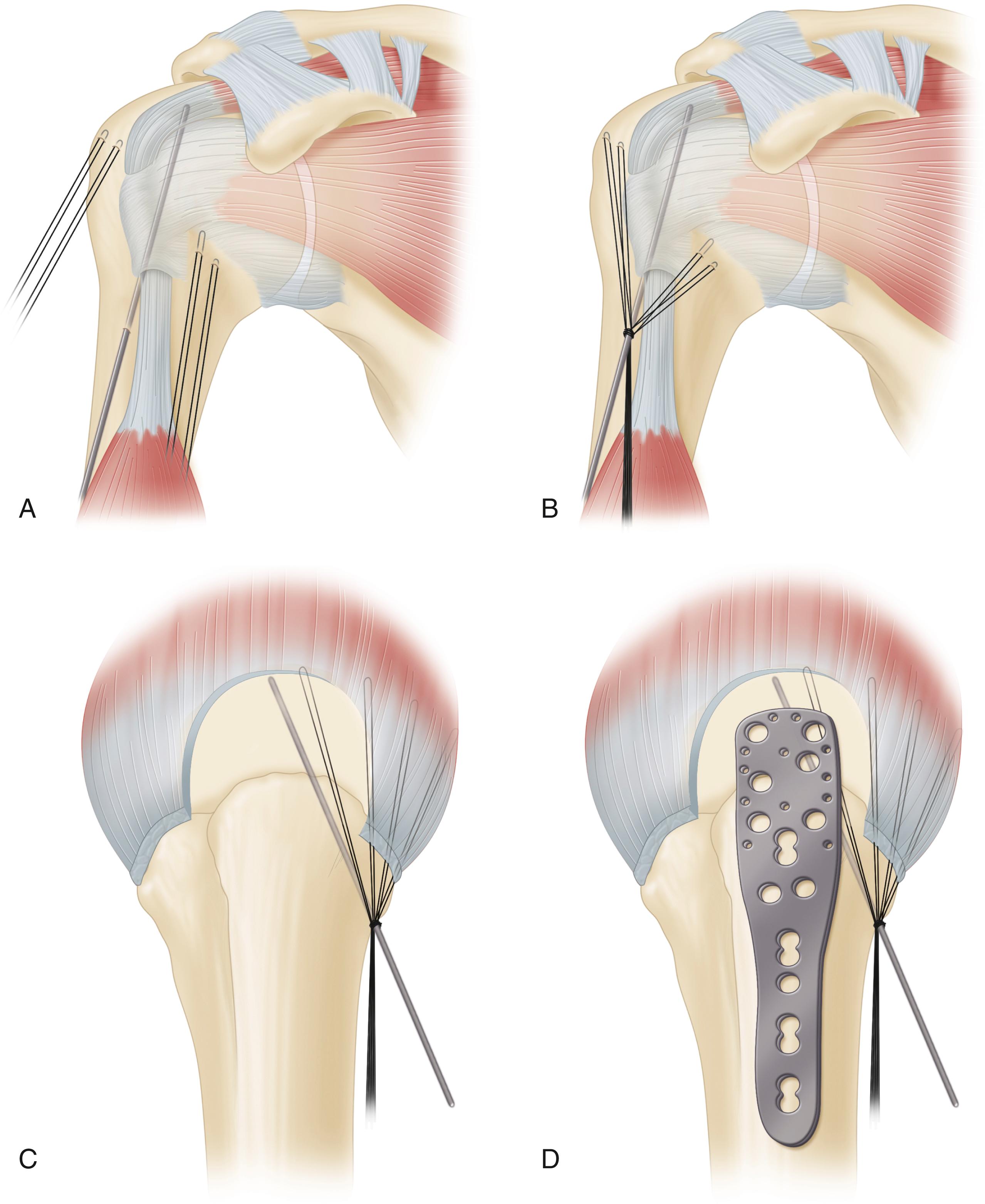 FIGURE 57.30, Fixation of proximal humeral fracture after valgus impaction osteotomy. A , Long Steinmann pin is placed from shaft into head segment. B , Traction sutures are tensioned and tied to pin. Tensioning sutures pulls head segment out of varus. C , Lateral view of proximal humerus after provisional fixation; note that position of pin and sutures allows unobstructed access for definitive fixation with precontoured locking plate ( D ).