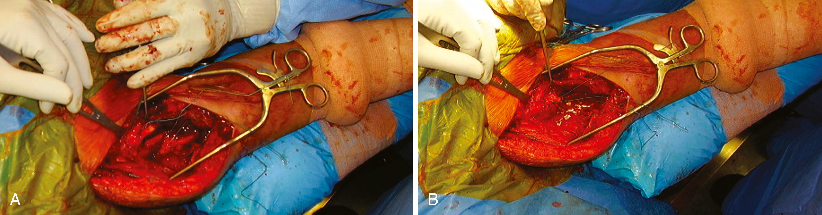 FIGURE 57.39, Open reduction and internal fixation of proximal humeral shaft fracture (see text). A and B, Sutures used for reduction and fixation of tuberosity fragments. SEE TECHNIQUE 57.5.