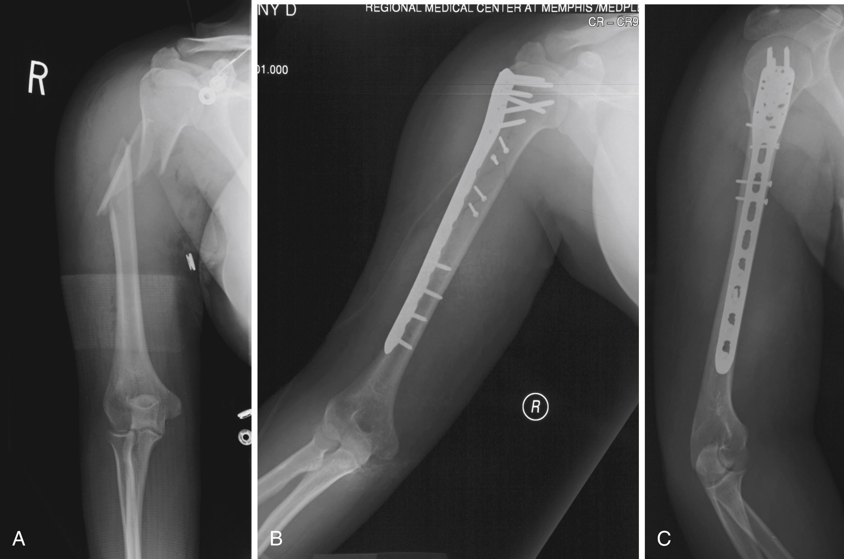 FIGURE 57.44, A, Segmental shaft fracture with extension into proximal humerus. B and C, Long plate used to obtain secure fixation.