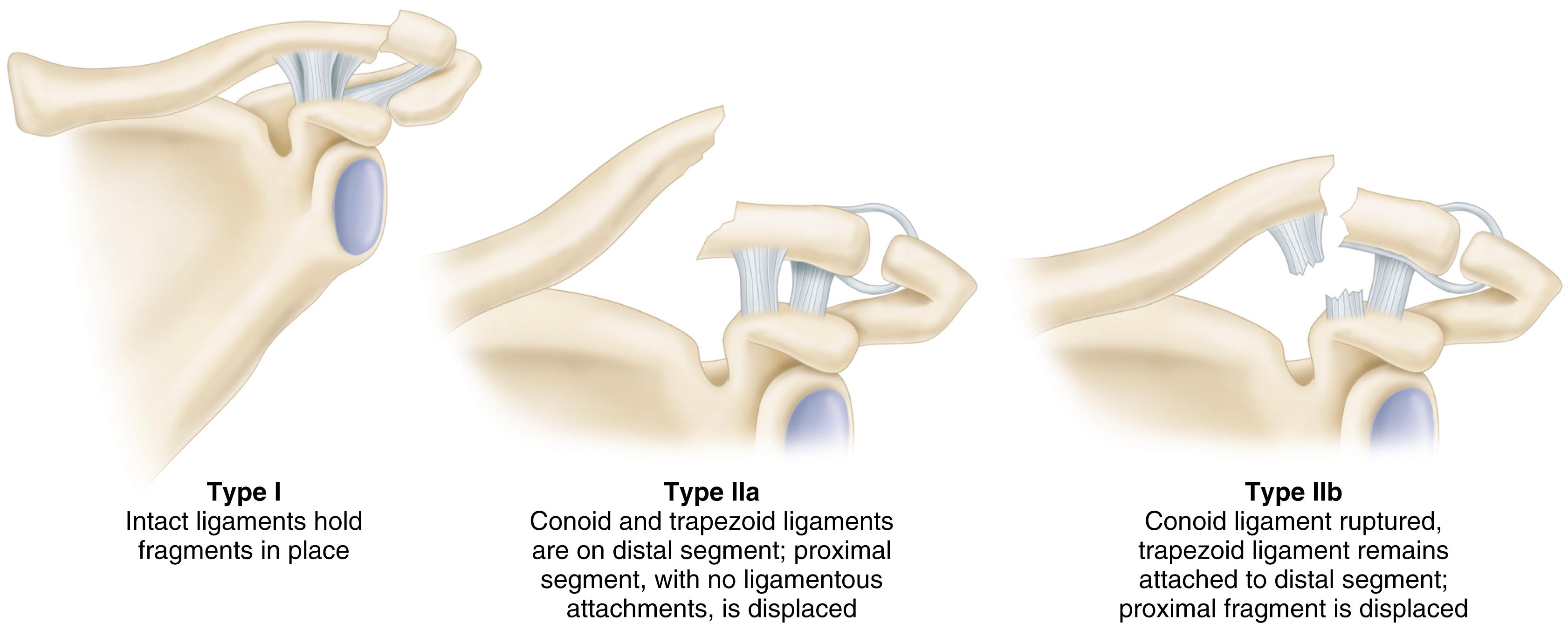 FIGURE 57.7, Neer classification of lateral clavicular fractures.