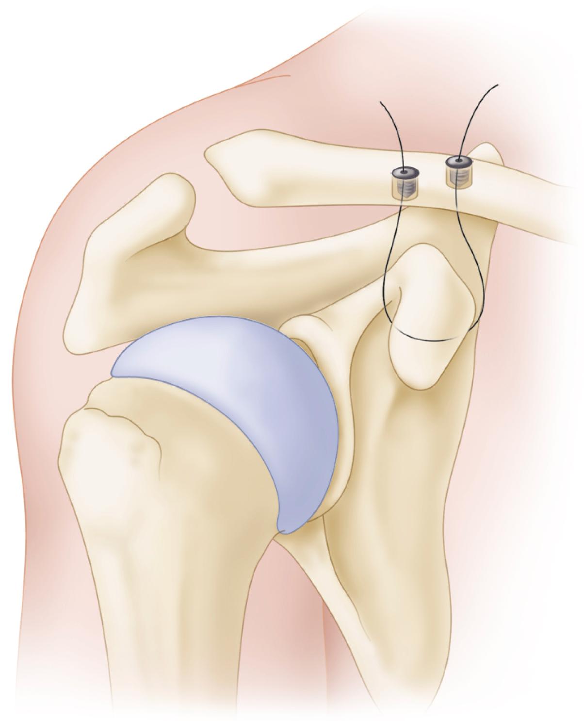 FIGURE 57.9, Supplemental suture fixation from clavicle to coracoid over the acromion for lateral clavicular fracture.