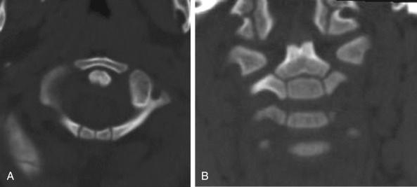 Fig. 10.2, (A) Axial computed tomography (CT) scan demonstrating ossification centers and multiple synchondroses of C1 in a 19-month-old patient. (B) Coronally reformatted CT scan demonstrating ossification centers of C2 in the same patient.