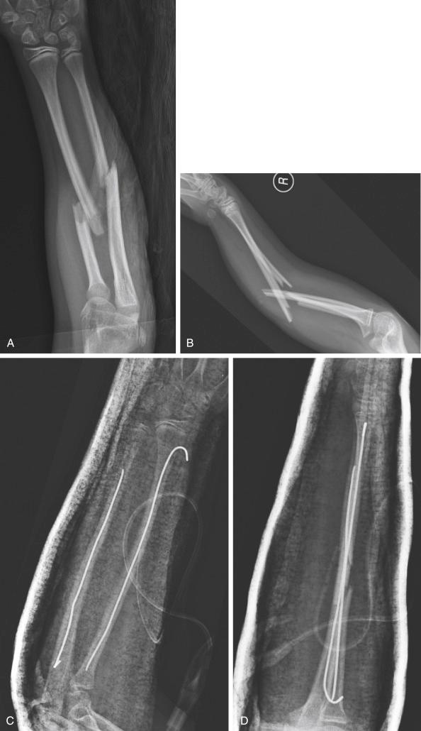 Fig. 6.1, Anteroposterior (A) and lateral (B) radiographs of an 8-year-old female who sustained a type I open fracture of both bones of the right forearm. She underwent urgent irrigation and débridement of the open fracture and elastic intramedullary nailing of both bones with the use of 1.5-mm nails. A prophylactic volar compartment fasciotomy of the forearm was also performed along with insertion of a surgical drain. Postoperative anteroposterior (C) and lateral (D) radiographs with an overlying splint demonstrate the aforementioned findings.