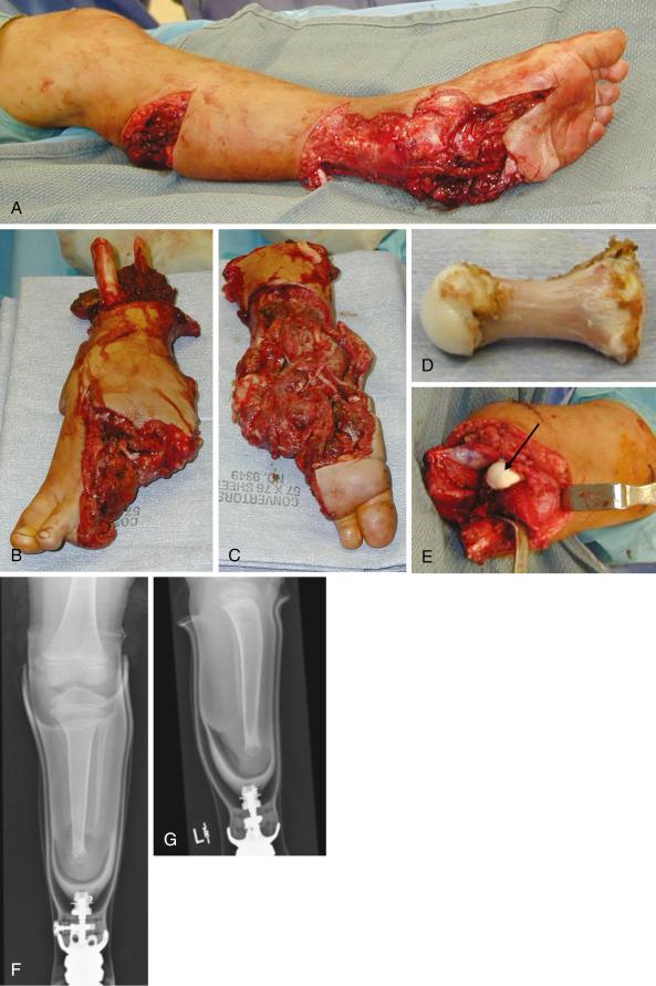 Fig. 6.2, A 6-year-old boy after a severe lawn mower injury to his left leg (A). This injury was not suitable for reconstruction. He underwent a below-knee amputation. Dorsal (B) and plantar (C) views of a portion of the amputated specimen are seen. The first metatarsal retrieved from the amputated foot was placed into the intramedullary canal of the tibial stump to function as an osteochondral graft (D) so that stump overgrowth would be prevented. Osteochondral graft positioned in tibia during below-knee amputation below-knee amputation (E). He required a split-thickness skin graft. Anteroposterior (F) and lateral (G) radiographs of the amputation stump 1 year later demonstrating complete incorporation of the intramedullary graft. He did not have any stump overgrowth over the next few years.