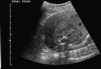 Fig. 128.1, Bilateral renal agenesis manifesting as absence of kidneys in the renal fossae bilaterally on grayscale imaging. Associated anhydramnios is also present.