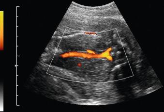 Fig. 128.2, Bilateral renal agenesis manifesting as absence of renal vessels bilaterally on ultrasound with color Doppler.