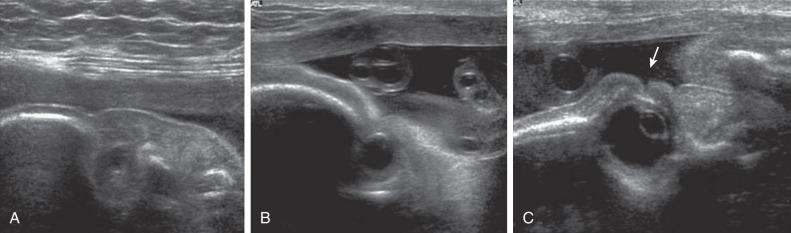 Fig. 128.3, (A and B) Sagittal US scan of right (A) and left (B) orbits shows bilateral cryptophthalmos, microphthalmos on the right side, and absent anterior chamber differentiation of the eyeball on both sides. (C) Similar section of the orbit of a normal fetus of the same gestational age shows the palpebral fissure ( arrow ) and the normal appearance of the eyeball with echoes from the lens and ciliary body dividing the cavity of the eyeball.