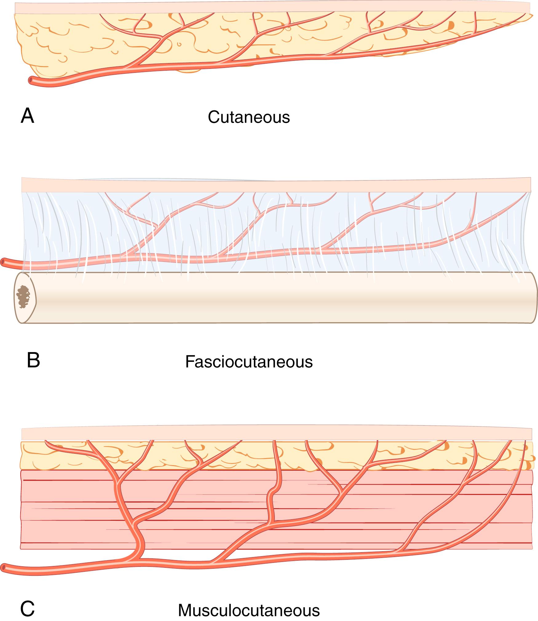 Fig. 45.1, Axial-pattern flaps are either cutaneous (A) , fasciocutaneous (B) , or musculocutaneous (C) , depending on the source of the major portion of the blood supply. Fasciocutaneous vessels commonly run in intermuscular septa and therefore supply the periosteum of underlying bone. The flap can be taken with a segment of that bone when necessary.