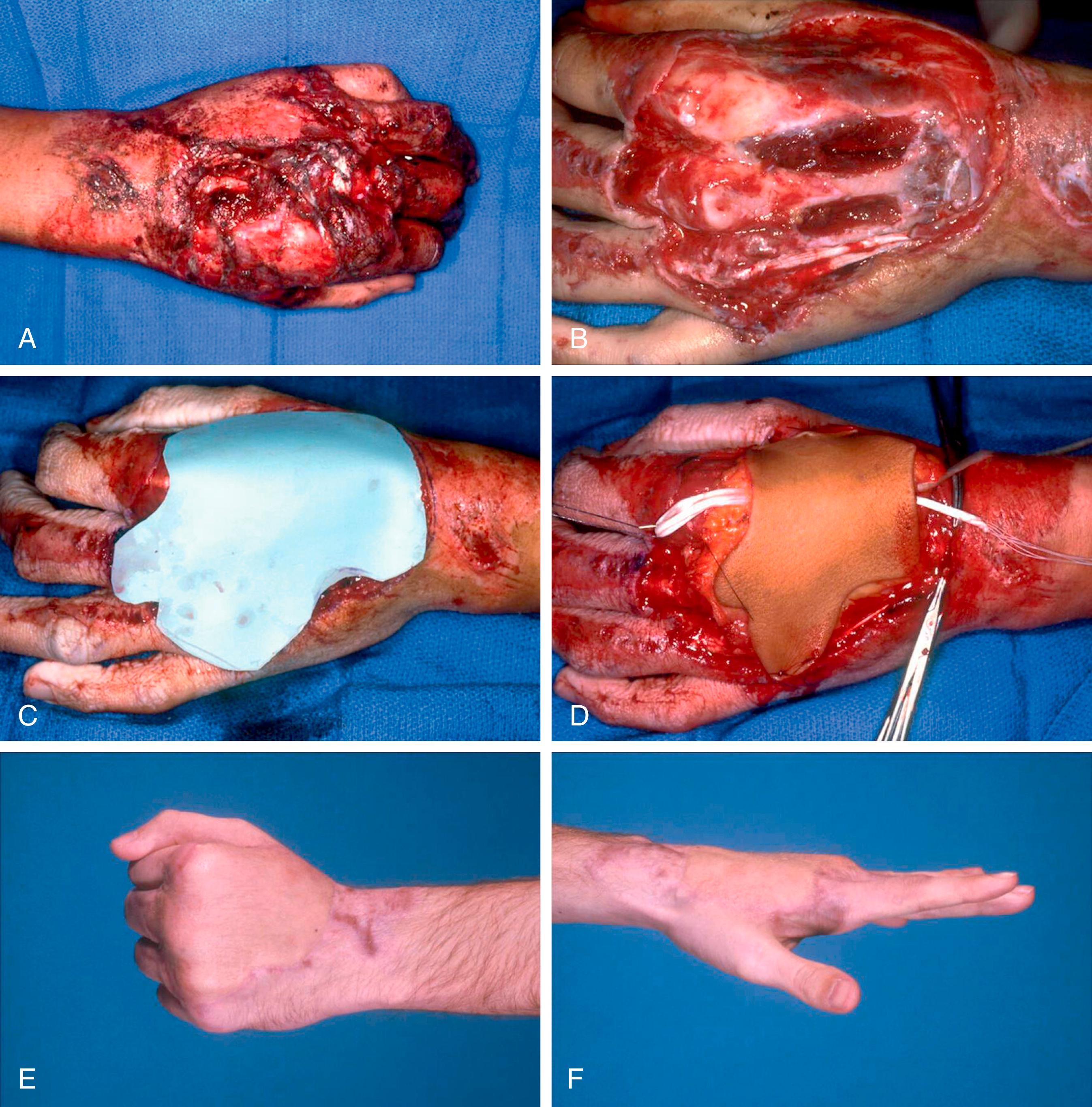 Fig. 45.2, A, This patient sustained a rollover degloving injury of the left hand with a fracture of the distal radius and segmental loss of the extensor tendons to the index and middle fingers. B, After radical debridement, the dorsal carpus was stabilized with Kirschner wires and the distal radius fracture was rigidly fixed with a “T”-plate. C, A template of the size and shape of the defect was made using a piece of Esmarch bandage. D, Immediate reconstruction of the dorsal wrist capsule using fascia lata and tendon grafting of the index and middle finger extensor tendons was performed. E, Postoperative appearance of the free groin flap used to reconstruct the dorsal soft tissue defect. F, Extensor tendon function of the index and middle fingers after primary tendon grafting beneath the free groin flap.