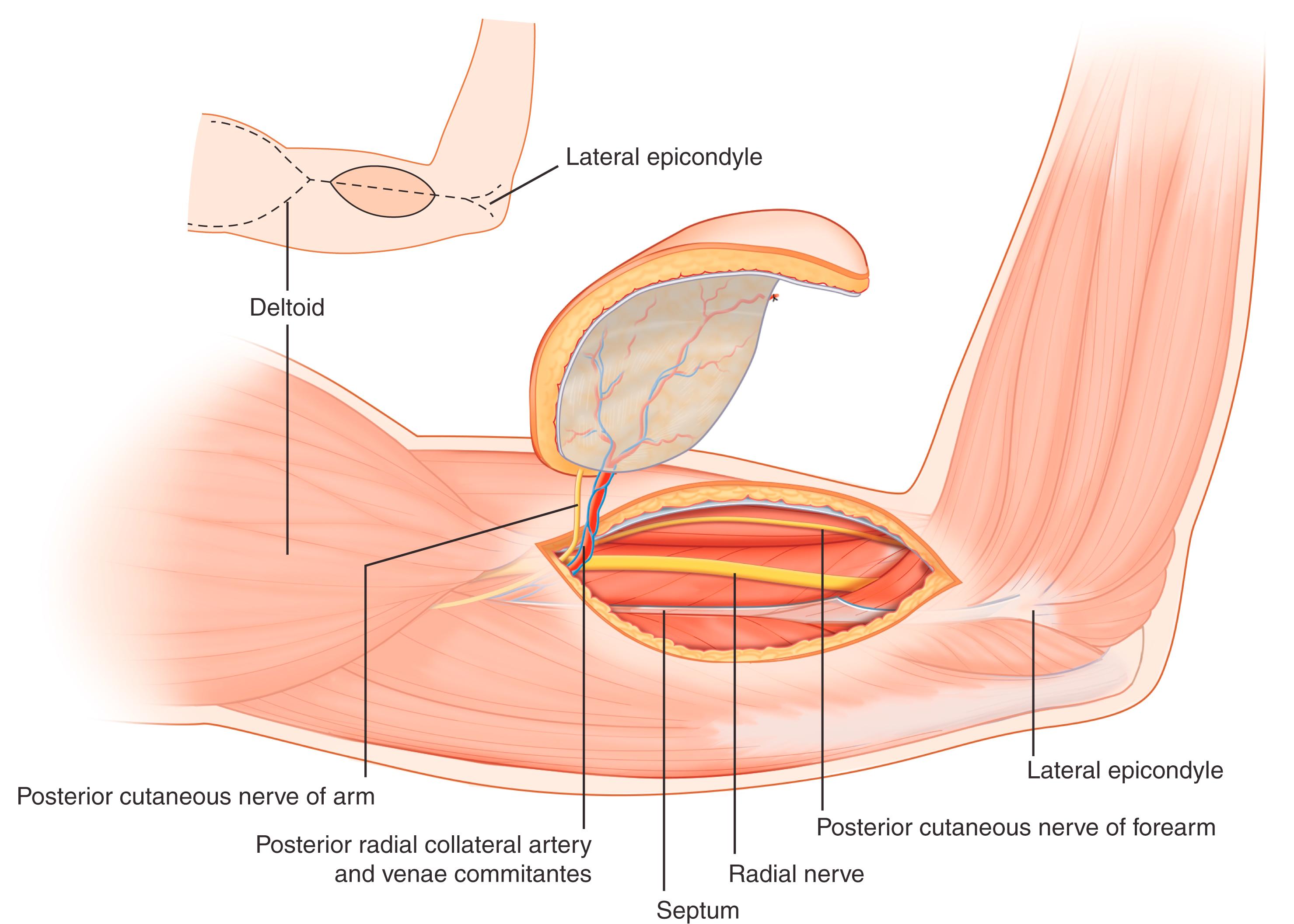 Fig. 45.3, The design and vascular and neural anatomy of a free lateral arm flap.