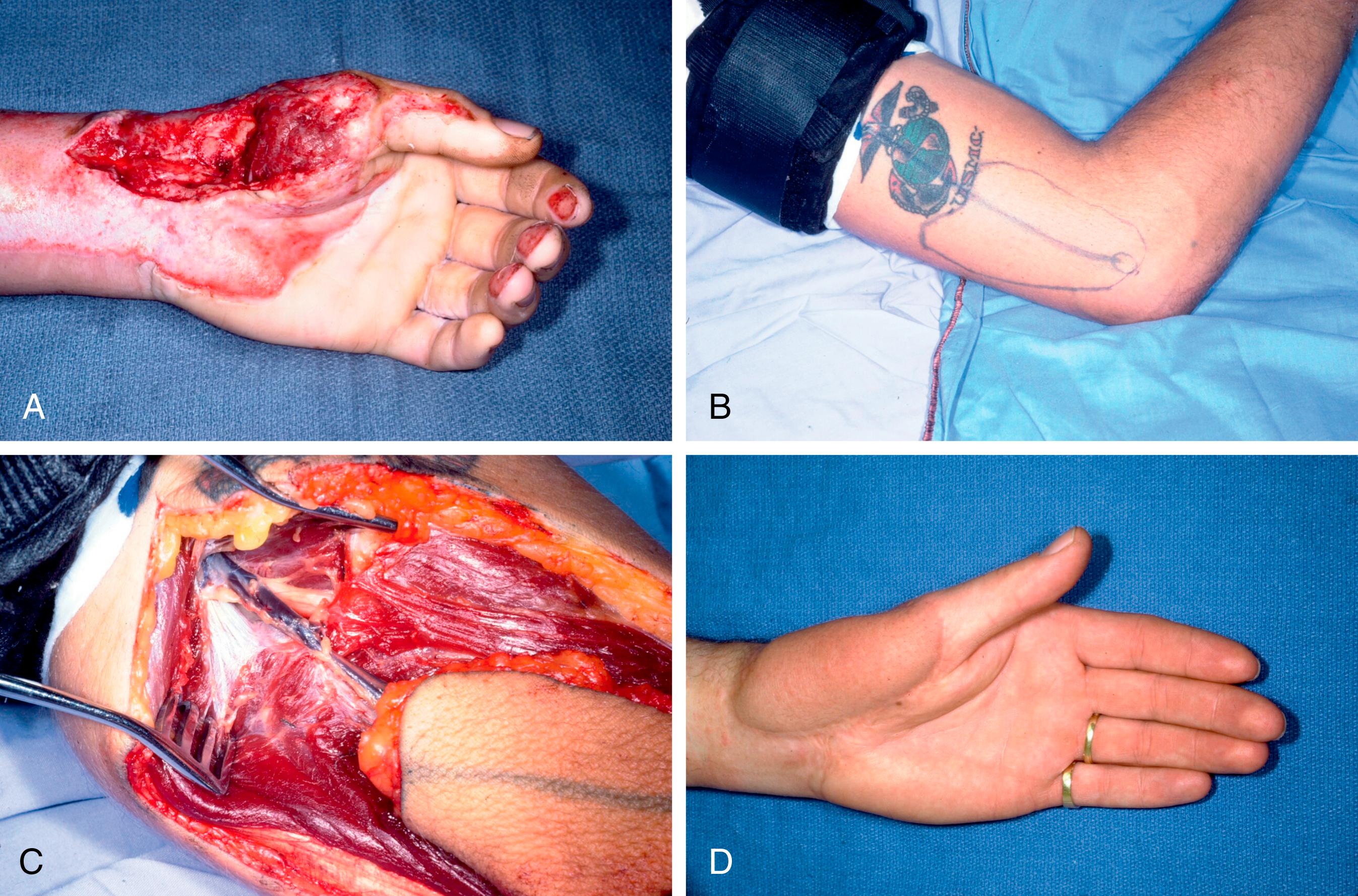 Fig. 45.4, Lateral arm flap. A, A 25-year-old man who sustained a thermal injury-avulsion of the soft tissues over the palmar aspect of his left wrist with an open wrist joint. B, Design of a lateral arm flap avoiding the tattoo. C, Dissection of the posterior radial collateral vascular pedicle in the septum between the brachialis anteriorly and the triceps posteriorly. The radial nerve can be seen in the superior aspect of the incision. D, Postoperative appearance of the healed lateral arm flap over the palmar aspect of the wrist and thumb.