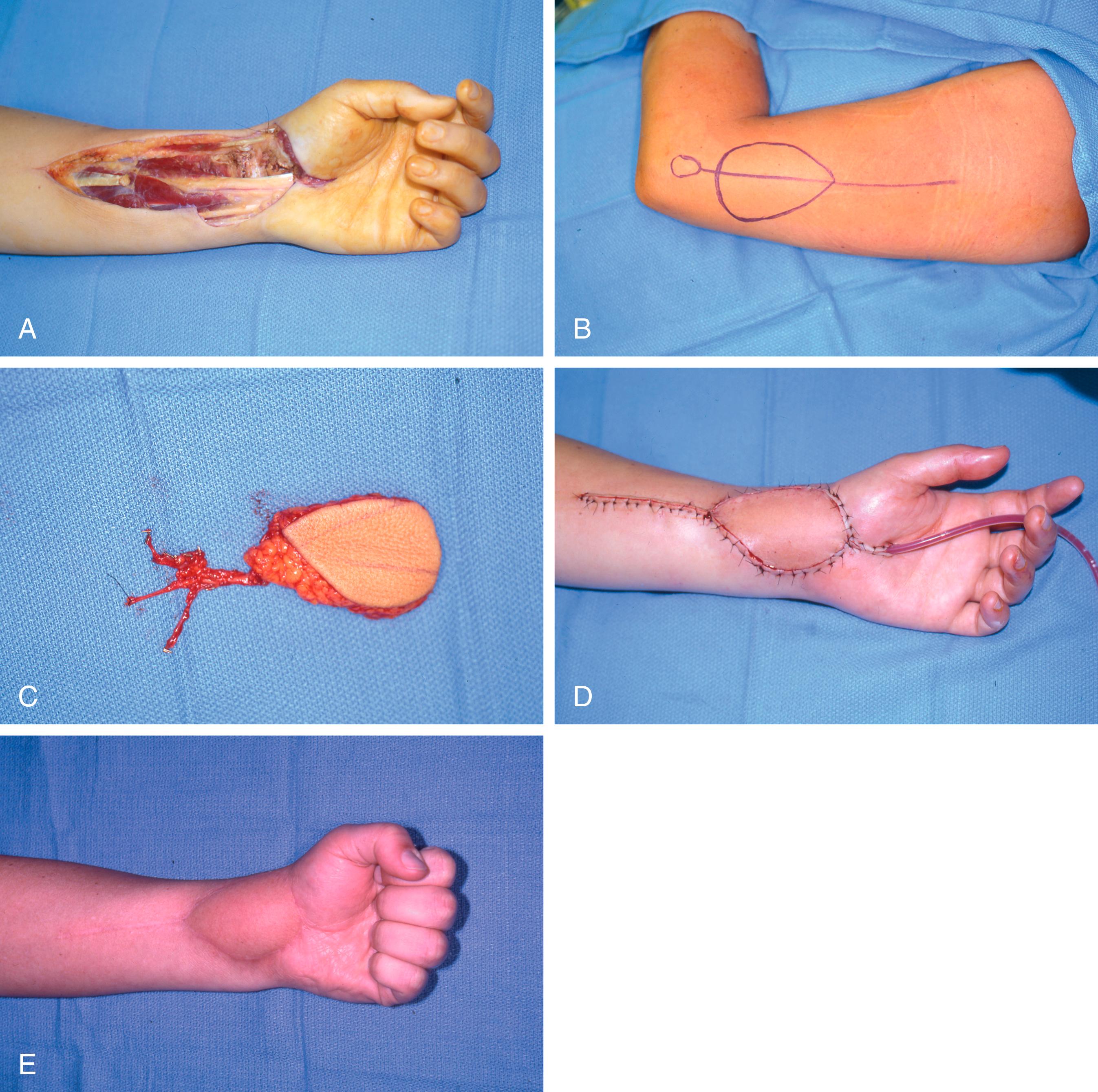 Fig. 45.5, Lateral arm flap. A, Soft issue defect over the palmar aspect of the left wrist after radical resection of a fibrosarcoma. B, design of an ipsilateral lateral arm flap based on the axis between the deltoid tubercle and the lateral epicondyle. C, Small lateral arm flap showing the posterior radial collateral artery and venae comitans and the posterior cutaneous nerve of the arm marked with a suture. D, Immediate postoperative result after end-to-end anastomosis of the posterior radial collateral artery to the radial artery and coaptation of the posterior cutaneous nerve of the arm to the palmar cutaneous branch of the median nerve. E, Postoperative appearance of the flap.