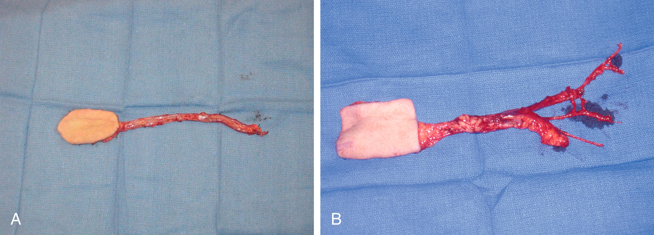 Fig. 45.6, Radial forearm flap. A, The thin supple skin of a small free radial forearm flap with a very long vascular pedicle of the radial artery and venae commitantes, which have been dissected all the way up to the elbow so that the microsurgical anastomoses of this free radial forearm flap can be performed much more proximal out of the zone of injury. B, The vascular pedicle of this free radial forearm flap has also been dissected up to the level of the elbow to incorporate the connections of the venae commitantes into the cephalic vein, so allowing a more “macro” microsurgical venous anastomosis.