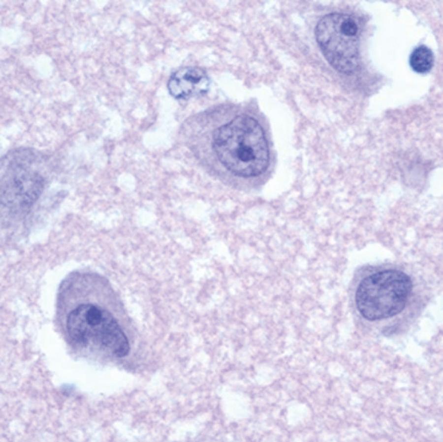 FIG. 273.2, Trophozoites of Naegleria fowleri in brain tissue stained with hematoxylin and eosin.