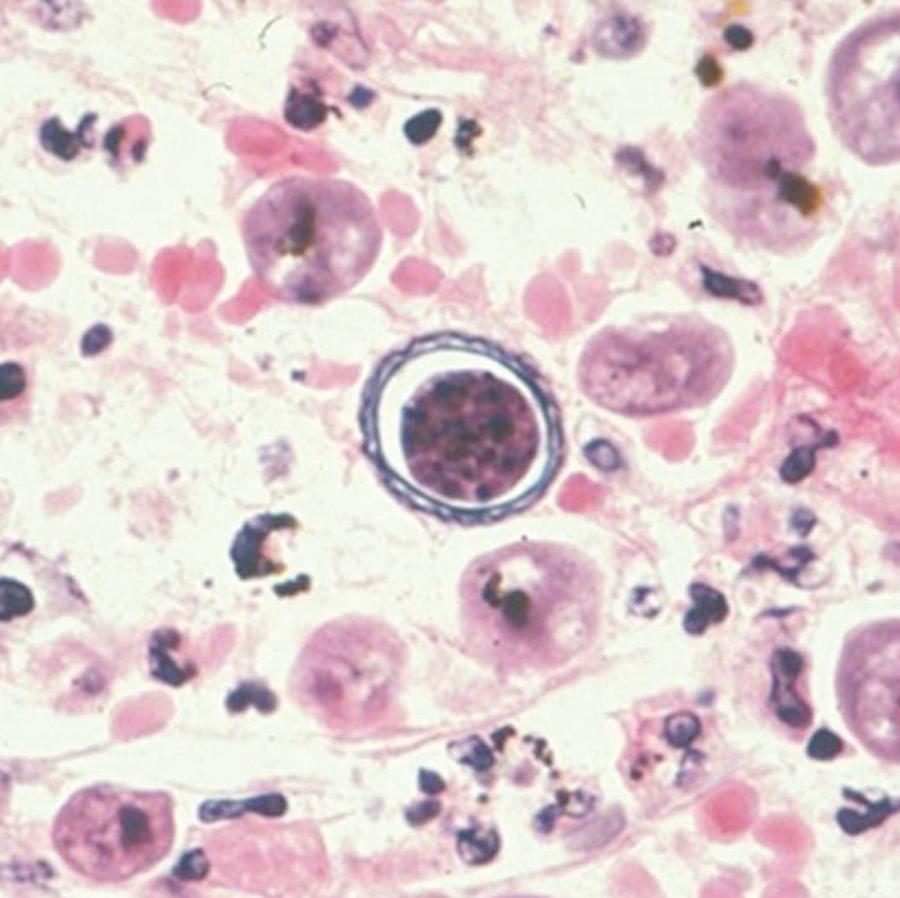 FIG. 273.4, Acanthamoeba cyst in brain tissue stained with hematoxylin and eosin.
