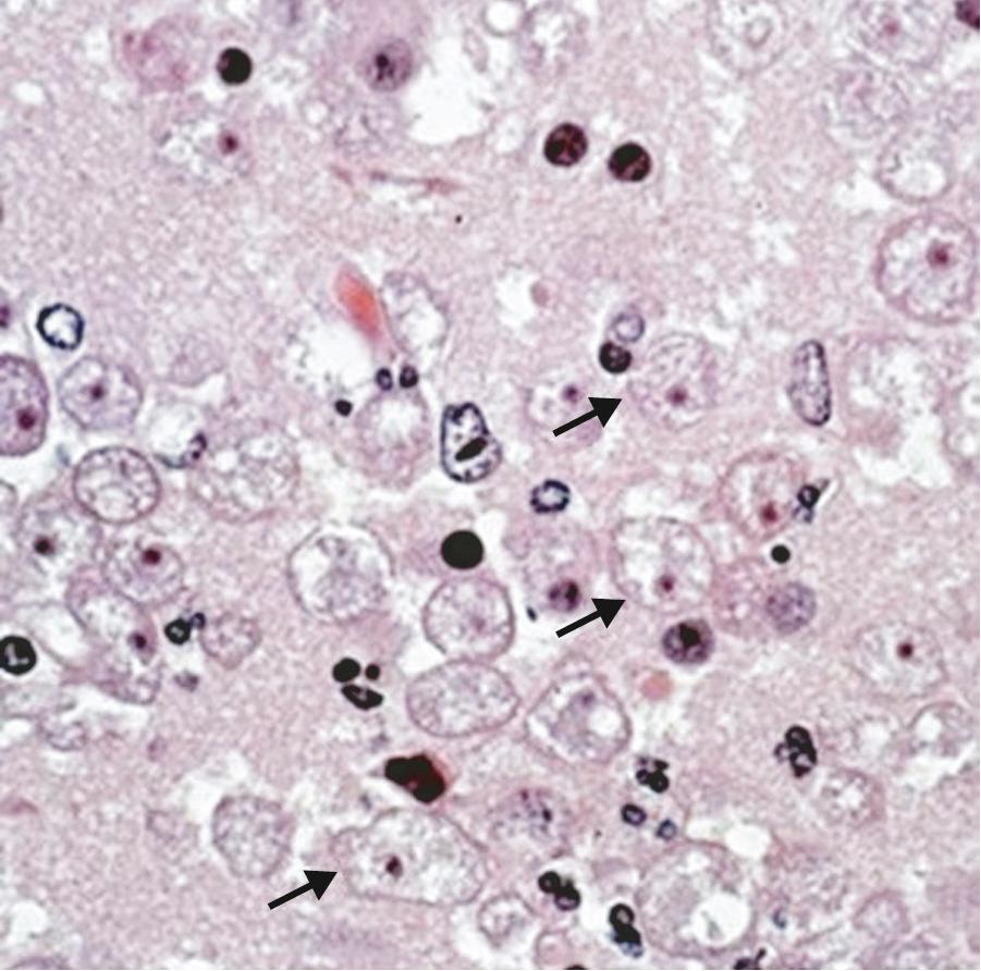 FIG. 273.5, Balamuthia trophozoites (arrows) in brain tissue stained with hematoxylin and eosin.