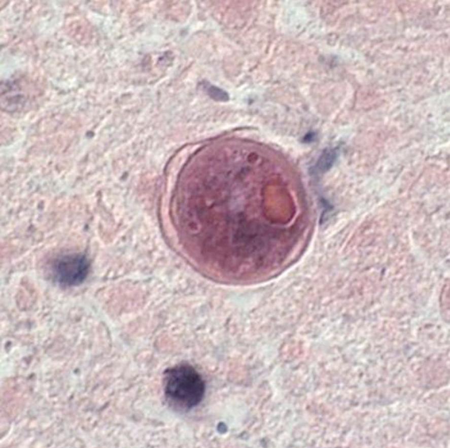 FIG. 273.6, Balamuthia cyst in brain tissue stained with hematoxylin and eosin.