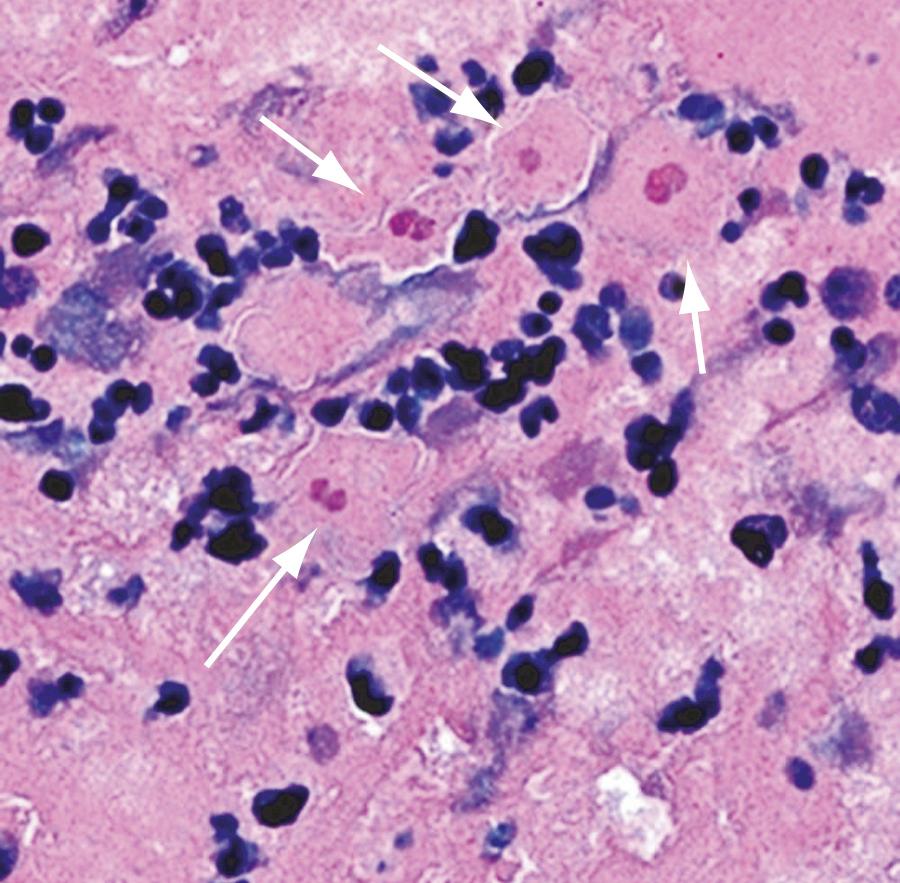 FIG. 273.7, Trophozoites of Sappinia (arrows) in brain tissue stained with hematoxylin and eosin.