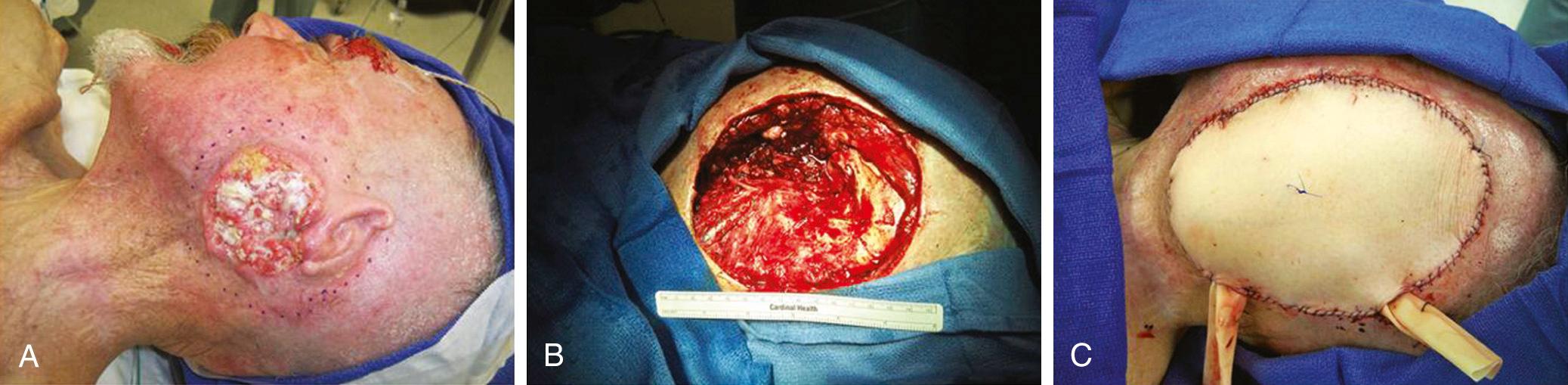 Fig. 78.2, Anterolateral thigh flap reconstruction of the lateral temporal bone defect.