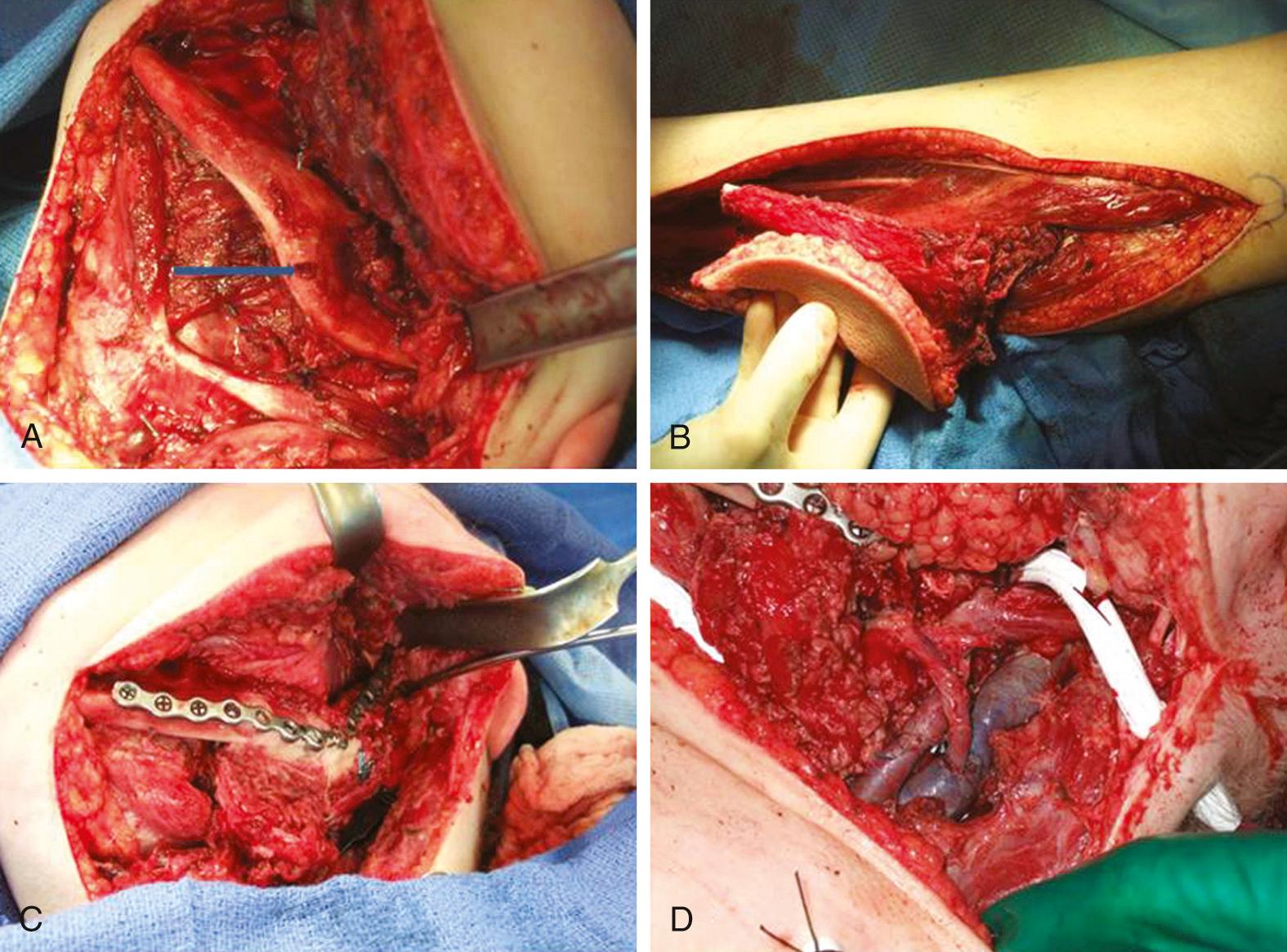 Fig. 78.3, Osteocutaneous fibula free flap reconstruction of the anterolateral defect of the mandibular arch.