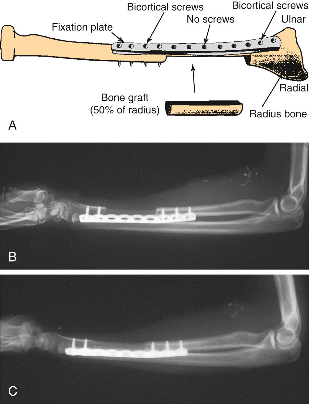 Fig. 78.5, Prophylactic fixation of the radius bone after bone graft harvest.