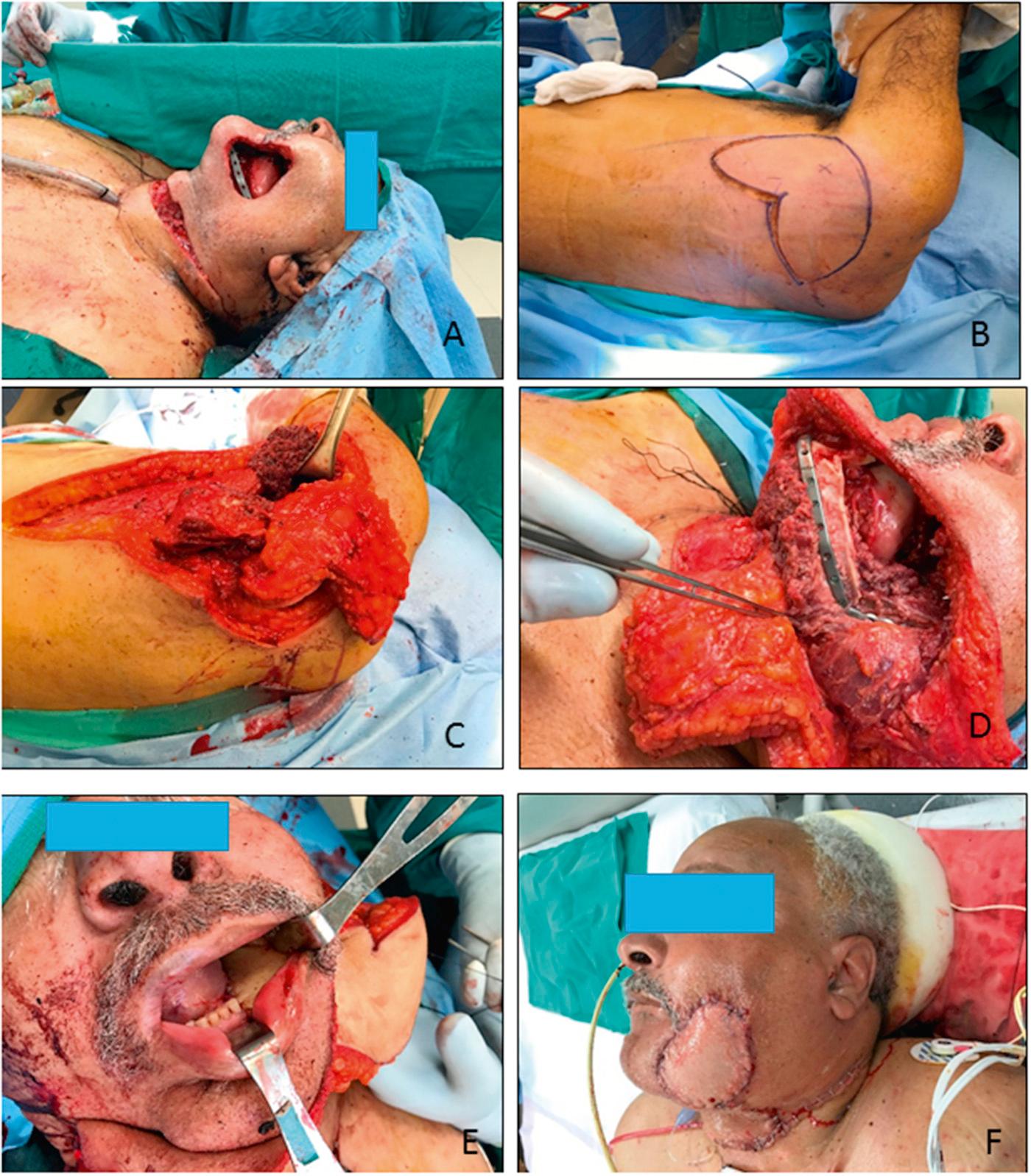 Fig. 78.6, Osteocutaneous scapula free flap repair of a large, three-layer defect of the anterior face and oral cavity.