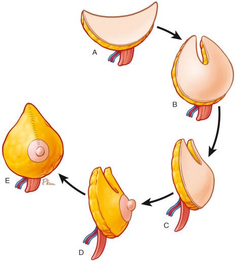 Fig. 7.2, The crescent of the flap is shaped by folding the superior edges together. The skin can be de-epithelialized to make an immediate nipple–areola reconstruction.