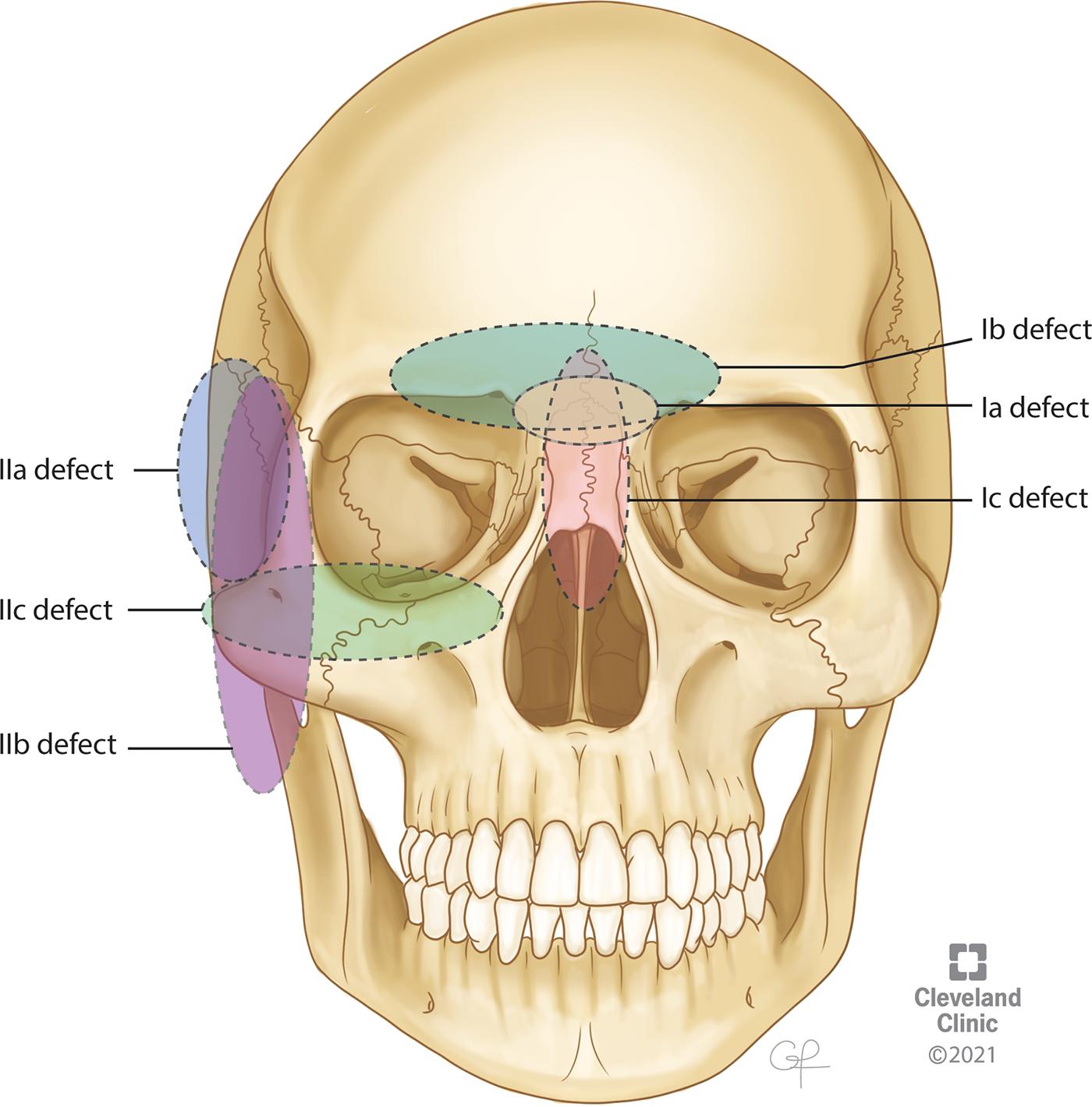 Fig. 37.1, Image depicting the regions explained by Yano et al to describe different areas of skull base defects.