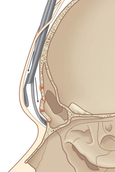 Fig. 1.7.11, Endoscopic subperiosteal dissection to expose the anterior table frontal sinus fracture.