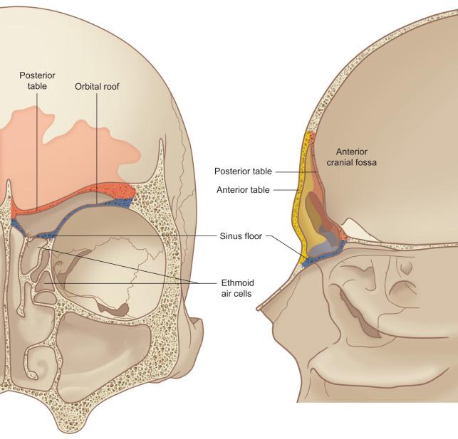 Fig. 1.7.2, Anterior and lateral views of the frontal sinus demonstrating a thick anterior table and relatively thin posterior table. The floor of the sinus forms the medial portion of the orbital roof. The posterior table forms a portion of the anterior cranial fossa. The anterior table forms part of the forehead, brow, and glabella.