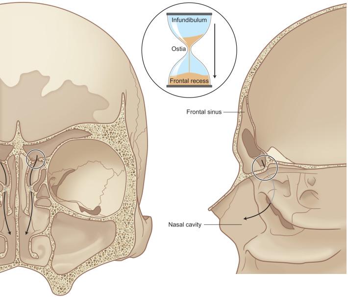 Fig. 1.7.3, The frontal sinus drainage pathway has an hourglass configuration with the infundibulum above and the frontal recess below.