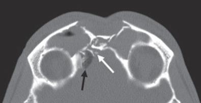 Fig. 1.7.4, Axial CT scan of a complex frontal sinus fracture. Note the displaced posterior table bone fragments ( white arrow ) and pneumocephalus ( black arrow ).