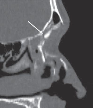 Fig. 1.7.5, Sagittal CT scan of a complex frontal sinus fracture. Note the involvement of the frontal sinus outflow tract.