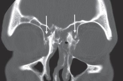 Fig. 1.7.6, Coronal CT scan of a complex frontal sinus fracture. Note the involvement of the medial orbital wall and the frontal sinus outflow tract ( white arrows ).