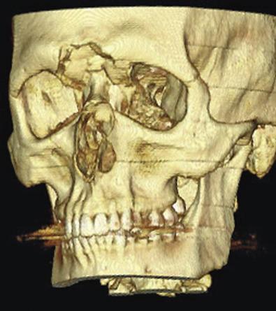 Fig. 1.7.7, Three-dimensional reconstruction of a complex frontal sinus fracture. The 3-dimensional representation gives the surgeon a better understanding of the size and location of the bone fragments. This can reduce the need for soft tissue dissection during surgery.