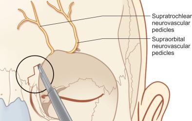 Fig. 1.7.8, Incision for a frontal sinus trephination, placed midway between the medial canthus and the glabella, and approximately 1 cm inferior to the brow. The incision is best hidden when placed inferior to the forehead curvature.