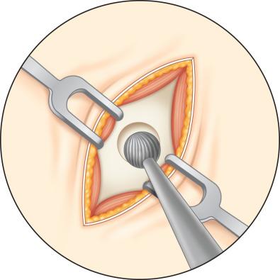 Fig. 1.7.9, Illustration of a cutting bur being used to trephinate the frontal sinus. Care should be used to avoid posterior table injury.