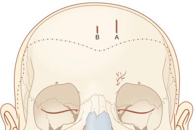 Fig. 1.7.10, Illustration of the “working” incision (A) and the “endoscope” incision (B) used for endoscopic repair of anterior table frontal sinus fractures.