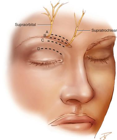 Fig. 32.1, Drawing showing three different incisions that can be made with respect to the brow. (A) Suprabrow incision. (B) Intrabrow incision. (C) Infrabrow incision. (D) Upper eyelid crease incision. The supratrochlear and supraorbital neurovascular bundles lie at the medial and lateral limits of the incision. n., Nerve.