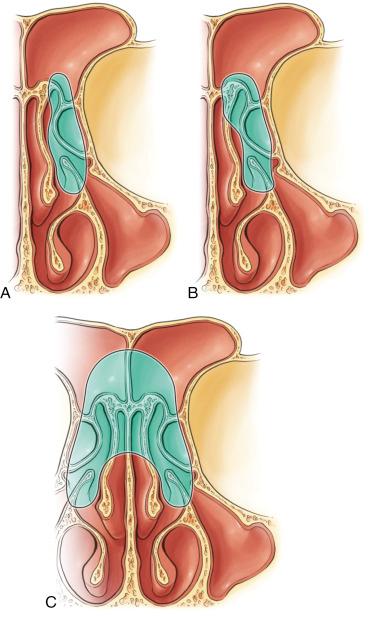 Fig. 10.1, Drawings showing areas of dissection in Draf extended frontal sinus approaches. (A) Boundaries of dissection for the Draf IIa procedure. (B) Boundaries of dissection for the Draf IIb procedure. The middle turbinate attachment at the floor of the frontal sinus is removed, as is the entire ipsilateral floor of the frontal sinus. The remainder of the middle turbinate is preserved. (C) The Draf III procedure is bilateral Draf IIb procedures combined with removal of the superior nasal septum and frontal intersinus septum.