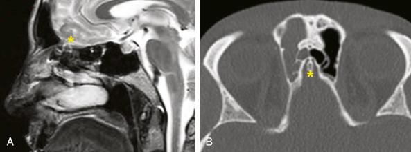 Fig. 10.2, Sagittal magnetic resonance image (A) and axial computed tomographic scan (B) showing the location of the olfactory fossa (asterisk). The surgeon should recognize the olfactory fossa as the lowest point in the floor of the anterior cranial base (A) and be aware of its anterior projection into the frontal sinus (B) .