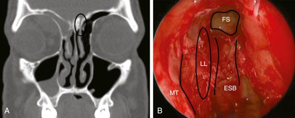 Fig. 10.3, (A) Coronal computed tomographic scan illustrating that the vertical portion of the middle turbinate is the medial boundary of the frontal recess (black oval). (B) Endoscopic image showing the middle turbinate (MT) attachment at the lateral lamella (LL) of the cribriform, which corresponds to the oval area in (A) . ESB, Ethmoid skull base; FS, frontal sinus ostium.