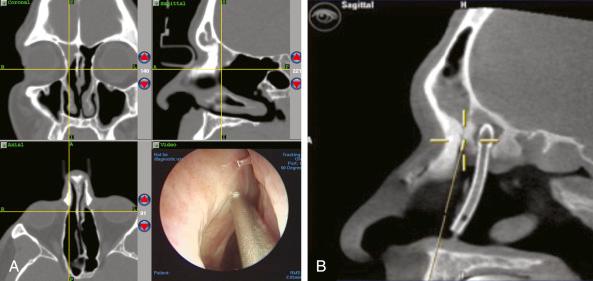 Fig. 10.4, (A) Triplanar computed tomographic (CT) image guidance display and intraoperative endoscopic view for a patient who underwent prior sinus surgery with partial middle turbinate resection. A lateralized middle turbinate remnant with associated osteitis was identified as the cause of his frontal sinus obstruction. (B) Sagittal CT scan for a patient who underwent six prior sinus surgeries, most recently with placement of a frontal sinus stent. The stent was located in a supraorbital ethmoid cell with significant surrounding neo-osteogenesis.