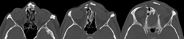 Fig. 10.5, Axial computed tomographic (CT) scans for a patient who underwent extensive repair of traumatic facial fractures over 10 years before developing a frontal sinus mucocele. CT images demonstrate neo-osteogenesis and hardware to be the sources of outflow obstruction.