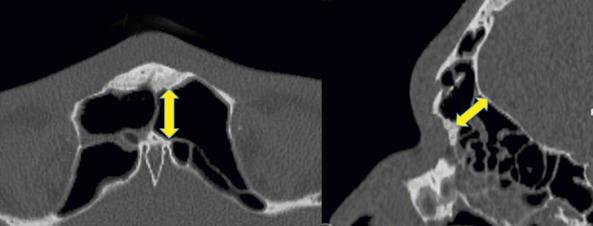 Fig. 10.6, Axial (left) and sagittal (right) computed tomographic scans for a patient with a frontal sinus fracture in whom hyperpneumatization with a large anterior-posterior diameter (yellow arrows) creates a favorable setting for endoscopic access.