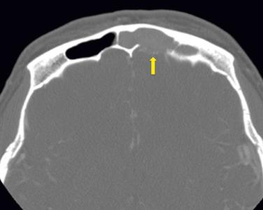 Fig. 10.7, Axial contrast-enhanced computed tomographic scan for a patient with allergic fungal sinusitis and posterior table dehiscence (yellow arrow).