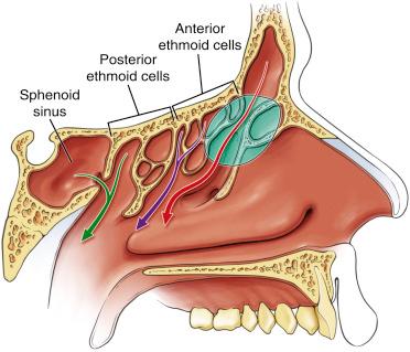 Fig. 9.1, Schematic drawing of drainage pathways in sagittal view. The frontal sinus drainage pathway is shown in red. The posterior ethmoid and sphenoid sinus drainage pathways through the sphenoethmoid recess are indicated in green. The drainage pathways from the anterior ethmoid are shown in purple. The green-shaded portion should be removed in frontal recess dissection.